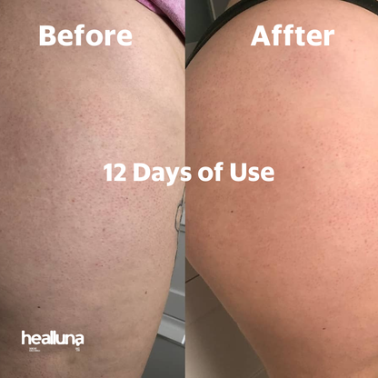 HealLuna Korean Body Acne Care Set – Body Cleanser & Body Cream