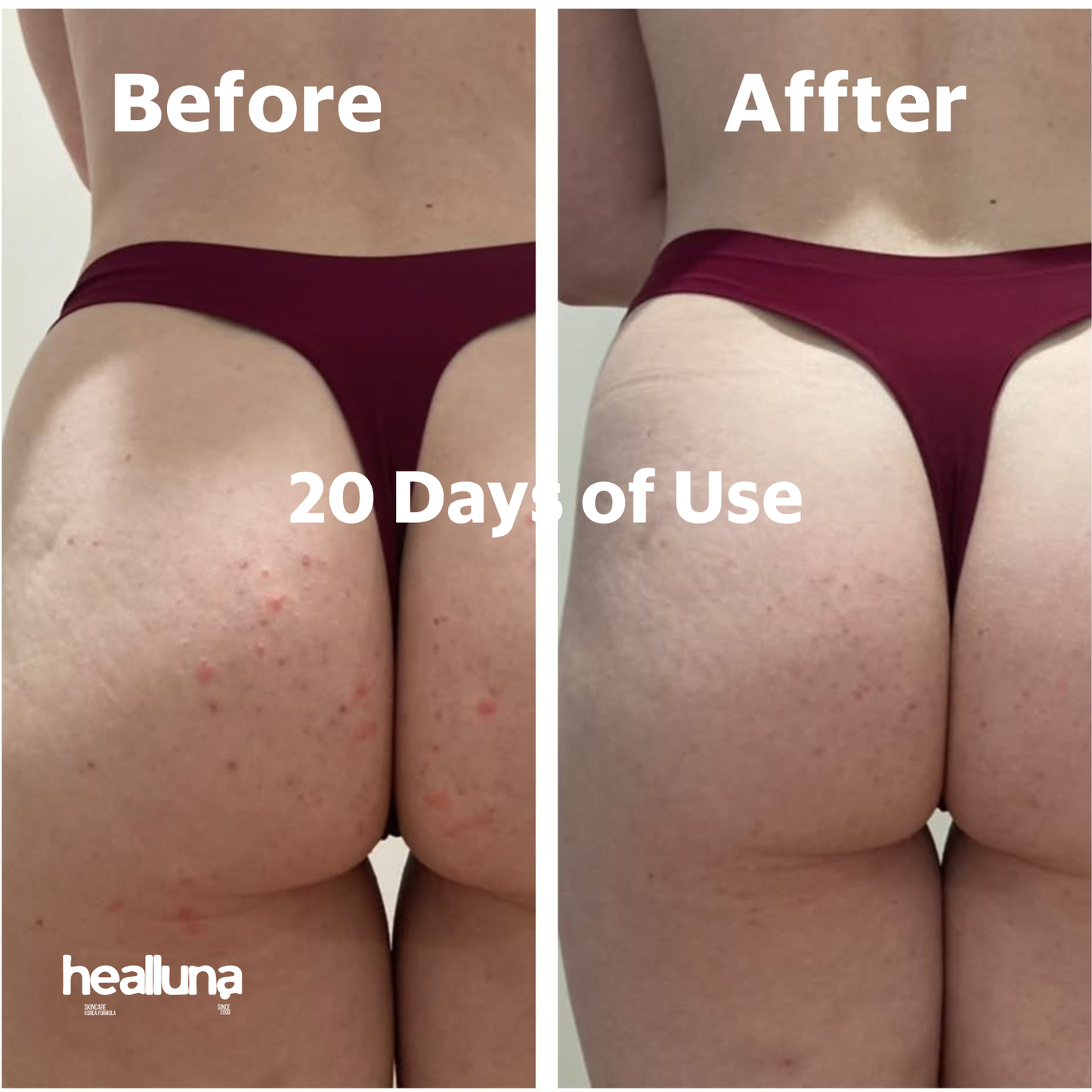 HealLuna Korean Body Acne Care Set – Body Cleanser & Body Cream