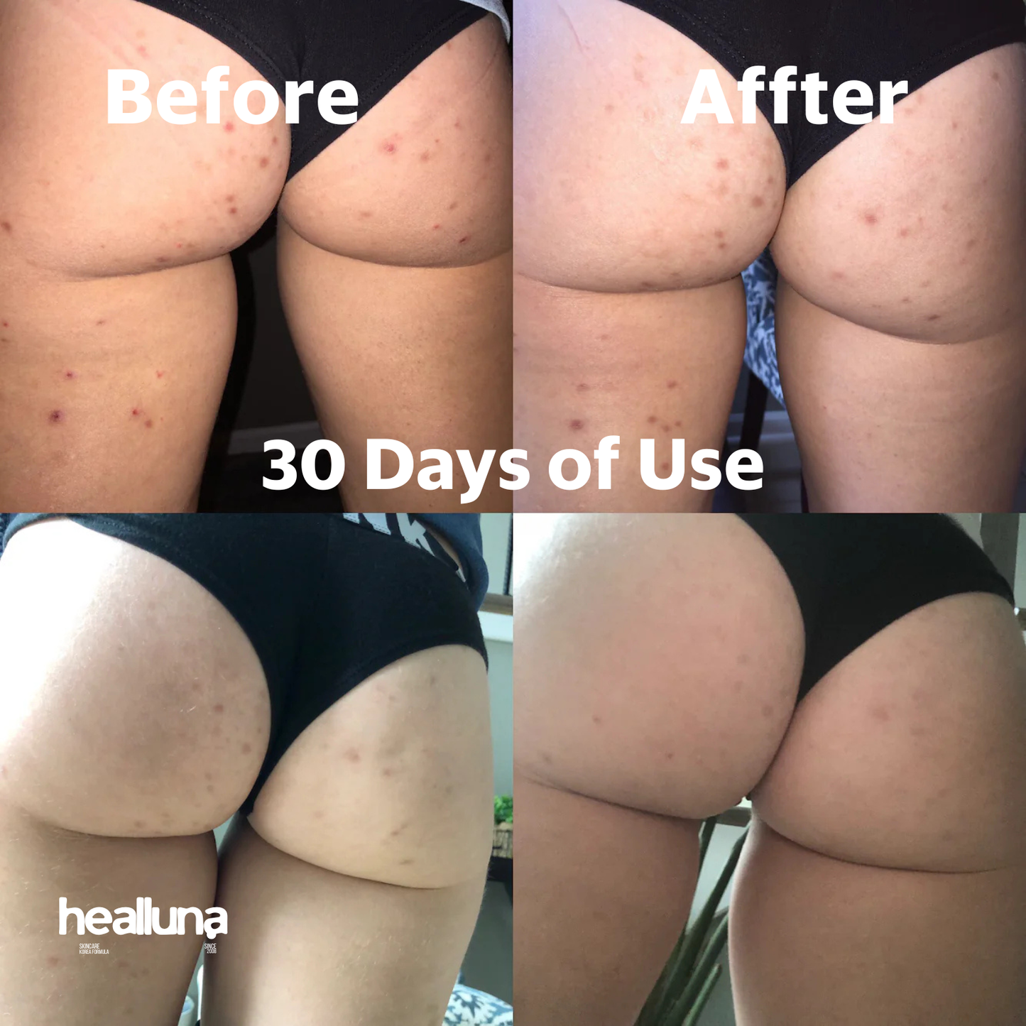 HealLuna Korean Body Acne Care Set – Body Cleanser & Body Cream