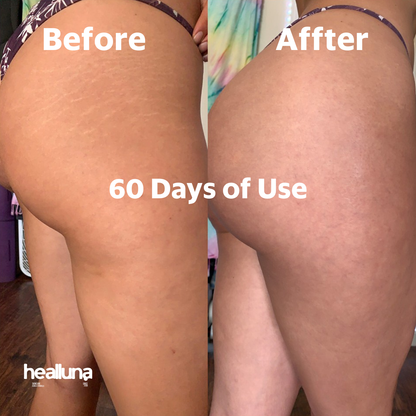 HealLuna Korean Body Acne Care Set – Body Cleanser & Body Cream