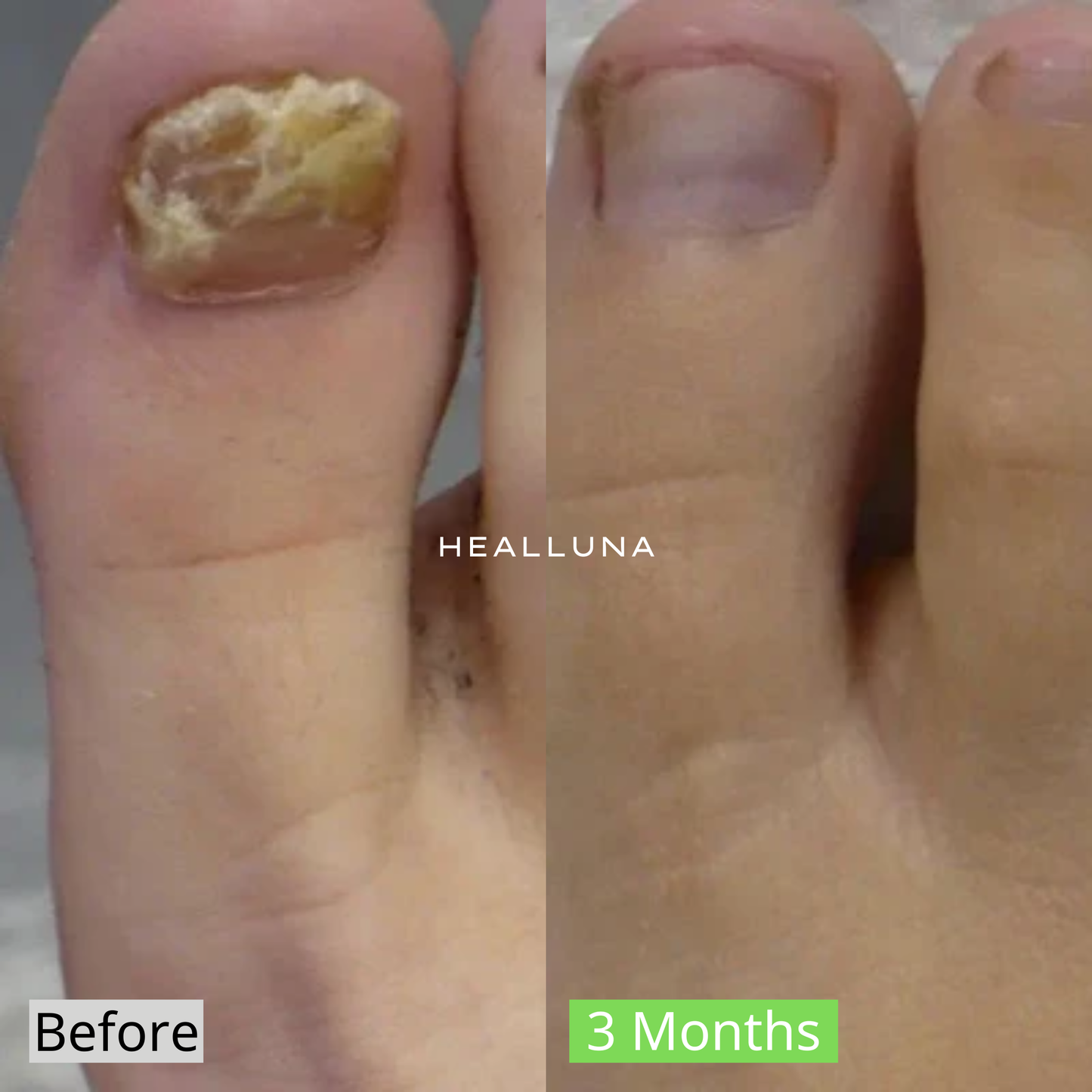 Healluna LaserPro™