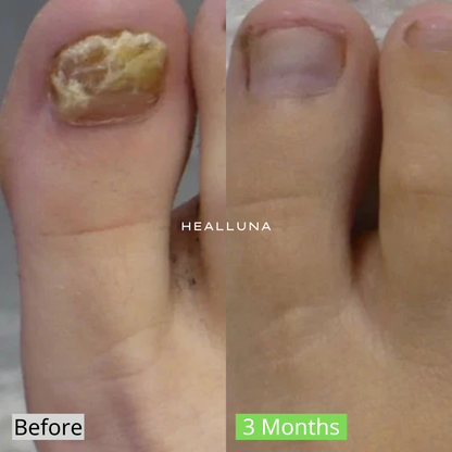 Healluna LaserPro™