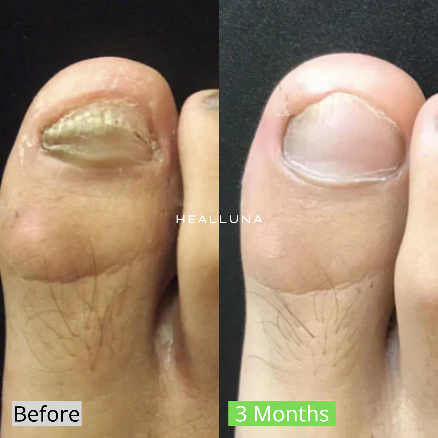 Healluna LaserPro™